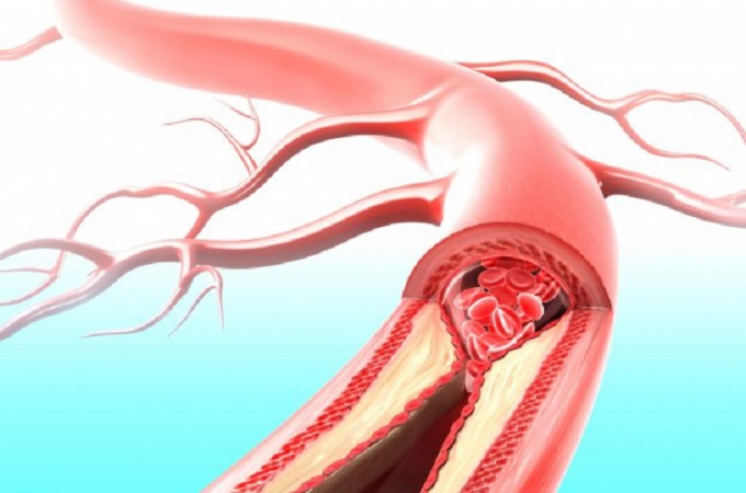 Atherosclerosis: tünetek, diagnózis, kezelés és megelőzés